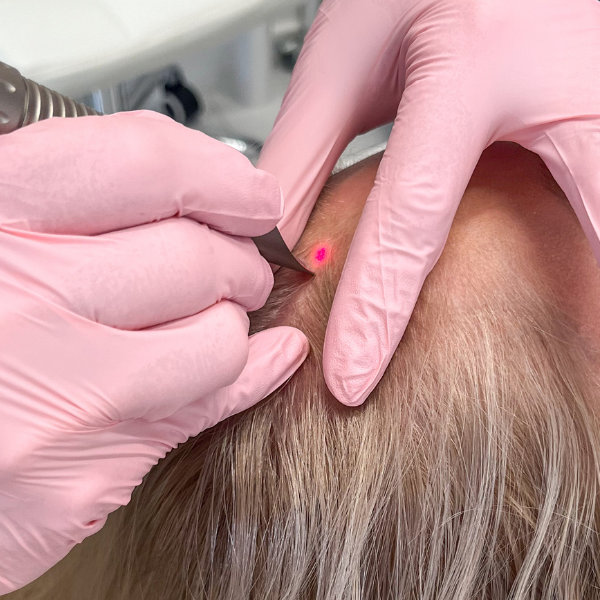 Vlasová laserová terapie HAIRestart